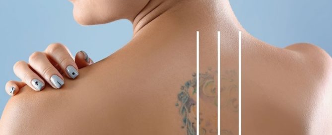 Tupelo Laser Tattoo Removal