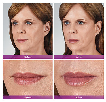 JuvÉderm Volbella® Before & After Tupelo, Ms