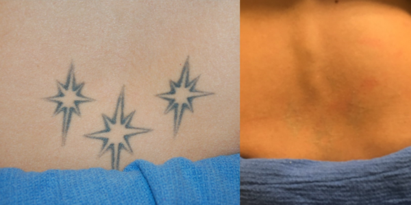 Alextrivantage Laser Tattoo Removal Tupelo, Ms