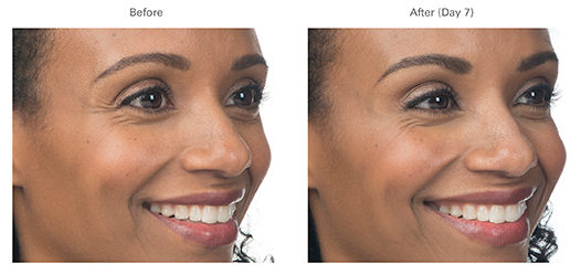 Botox Before & After Tupelo, Ms