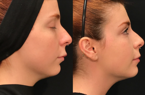 Kybella Before & After Tupelo, Ms