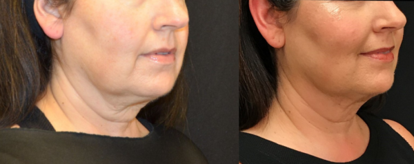 Kybella Before & After Tupelo, Ms