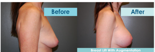 Breast Lift | North MS | Accent Surgery
