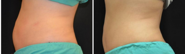 Coolsculpting Before & After Tupelo, Ms