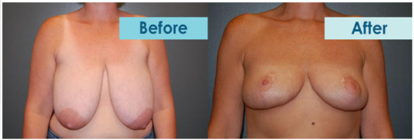 Breast Reduction Tupelo, Ms