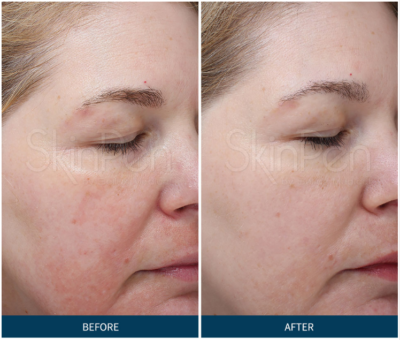 Skinpen Micro-needling Before & After Tupelo, Ms
