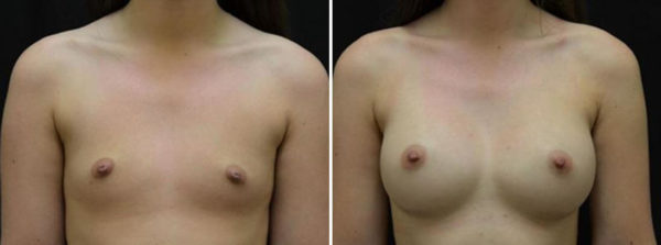 Breast Augmentation Tupelo, MS