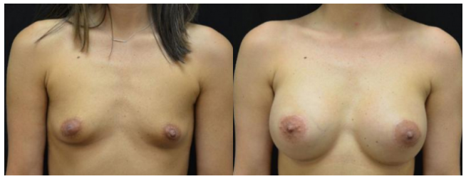Breast Augmentation Tupelo