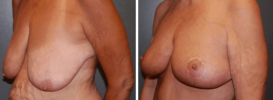 Breast Reduction Tupelo