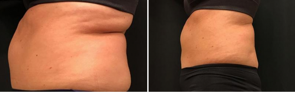 Liposuction Tupelo, Mississippi