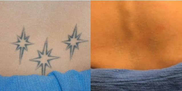 Laser Tattoo Removal Tupelo