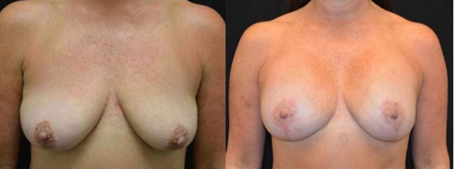 Breast Augmentation Tupelo
