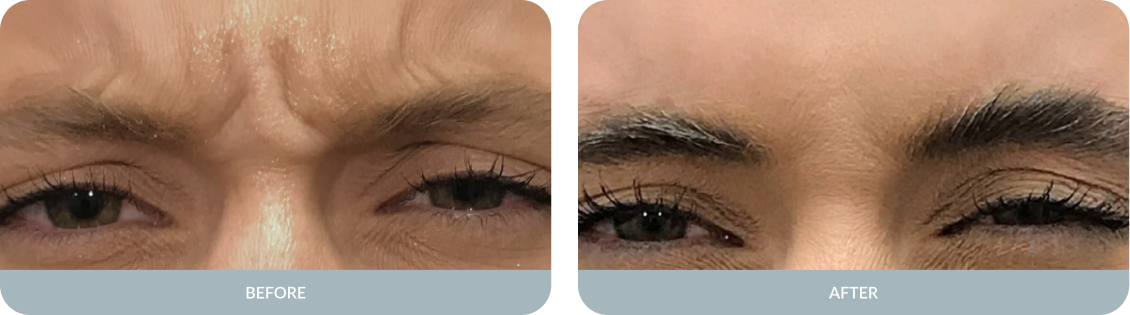 Botox Before and After Result Tupelo, Mississippi