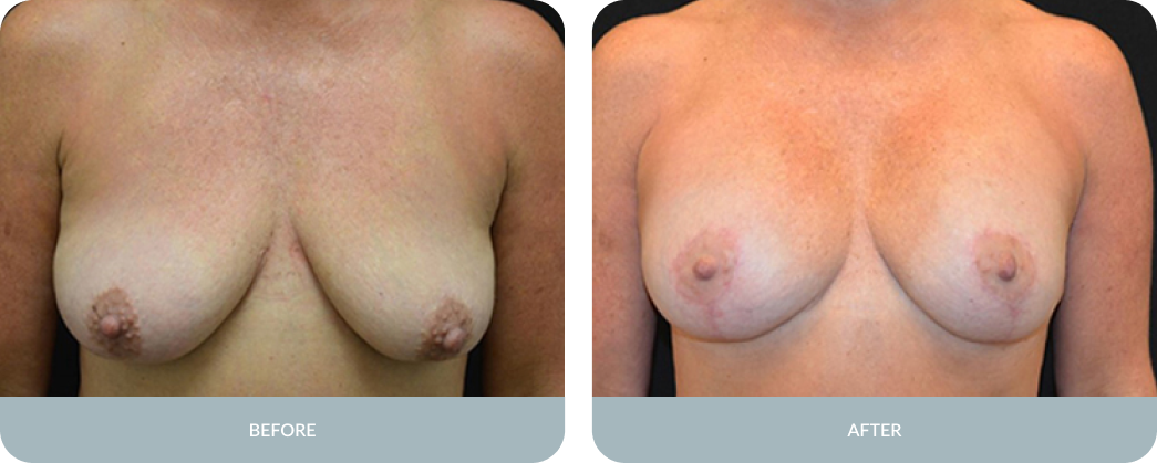 Breast Augmentation with Mastopexy Before and After Result Tupelo, Mississippi