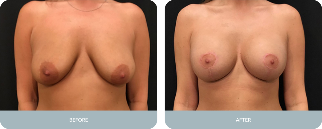 Breast Reduction Before and After Result Tupelo, Mississippi