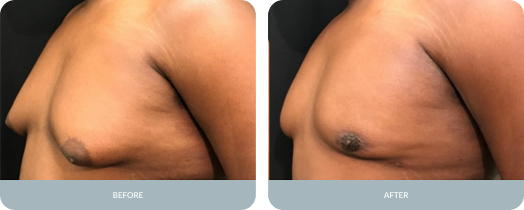 Gynecomastia Tupelo | Male Breast Reduction Mississippi