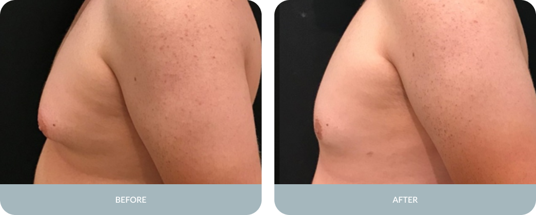 Gynecomastia Before and After Result Tupelo, Mississippi